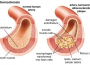 atherosclerosis_slice