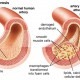 atherosclerosis_slice