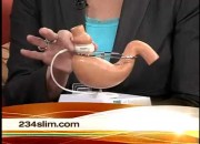 lapband surgery